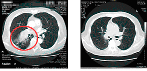 肺癌：新技术挽救工作狂人生命