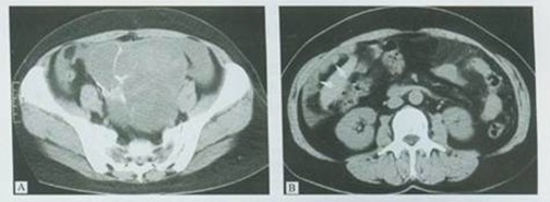 卵巢癌晚期：肿瘤明显缩小 成存期延长