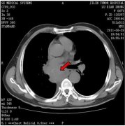 食管癌术后复发：热疗治疗三周期康复出院