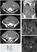 结肠癌：患者典型康复案例