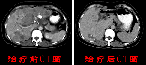 胃癌：69岁老人成功康复病例