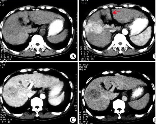 肝癌合并肝硬化：热疗成功康复案例