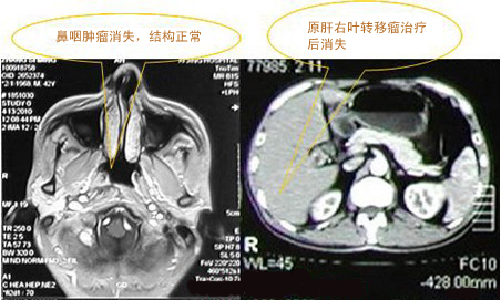 鼻咽癌：热疗治疗肿瘤后消失