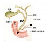 胆囊癌晚期：WB-1无创全身热疗治疗康复案例