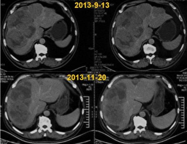 胃癌：新加坡患者慕名而来接受治疗