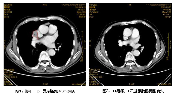 肺癌：最新治疗技术热死肿瘤