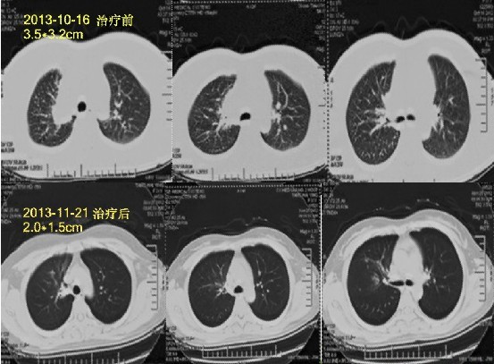 肺癌Ⅳ期：全身热疗+P53基因治疗2疗程健康出院