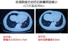 肺癌：多学科综合治疗肿瘤明显缩小