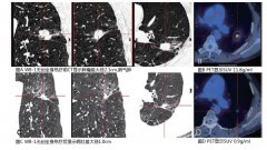 肺癌：多学科综合治疗效果显著