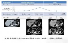 肺癌转移：热疗+P53基因治疗2个月稳定病情
