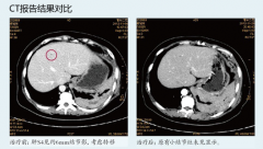 肺腺癌：肺腺癌晚期多处转移得到控制