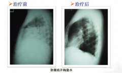 卵巢癌：WB-1无创全身热疗系统治疗转移灶消失