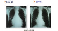 肺癌：患者绿色治疗之路