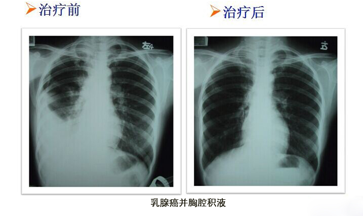 乳腺癌：WB-1无创全身热疗治疗同时提高自身免疫力