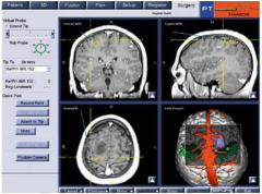 脑胶质瘤：P53基因热疗结合健康人细胞治疗让肿瘤消退