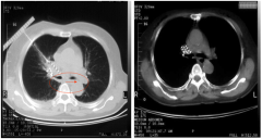 胡主任用全身热疗帮我死里逃生 胡主任用全身热疗帮我死里逃生